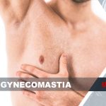 gynecomastia
